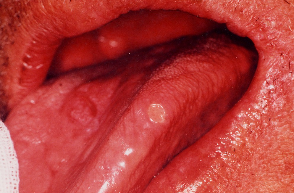 �A�t�^���������i���A�t�^�j�摜