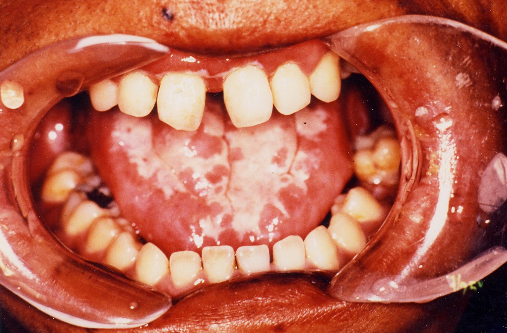 カンジダ症舌背部画像